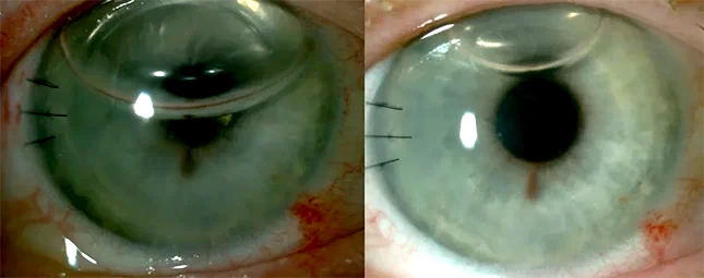 queratoplastia endotelial