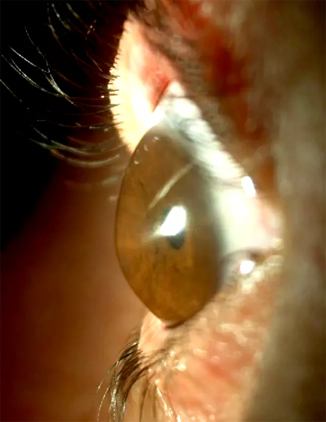 queratoplastia queratocono