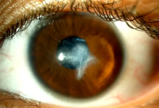 queratoplastia queratocono