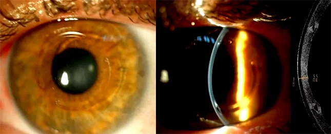 queratoplastia queratocono