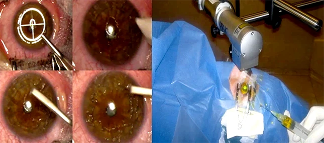 queratoplastia queratocono