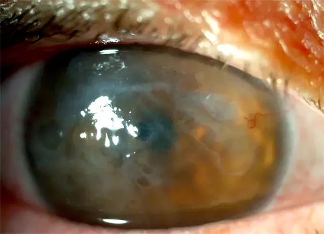 queratoplastia endotelial