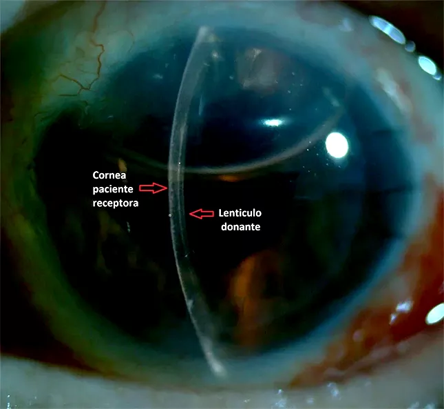 queratoplastia endotelial