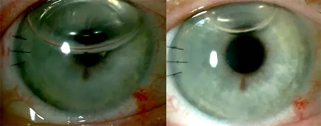 queratoplastia endotelial