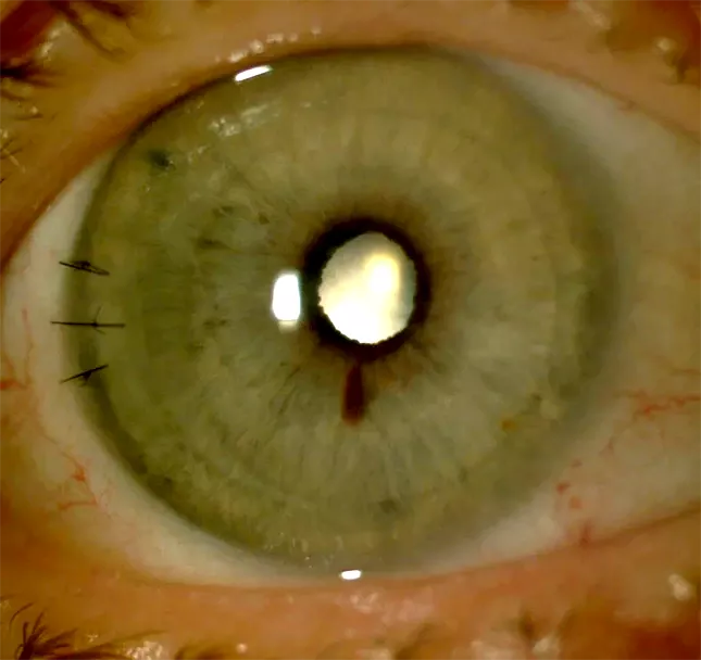 queratoplastia endotelial