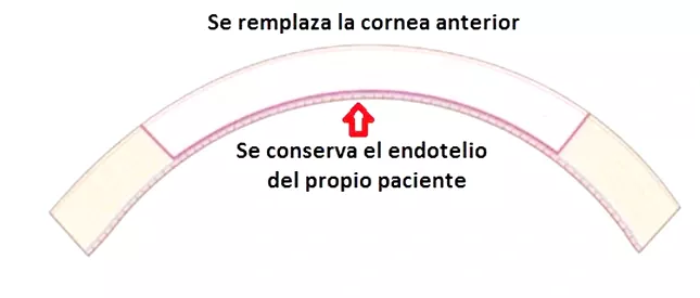 queratoplastia lamilar