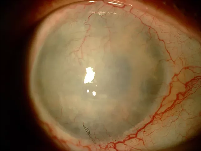 queratoplastia penetrante