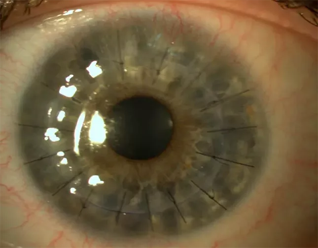 queratoplastia penetrante