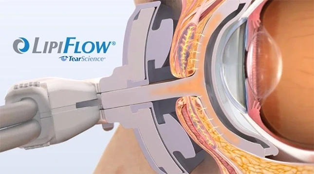 LipiFlow®