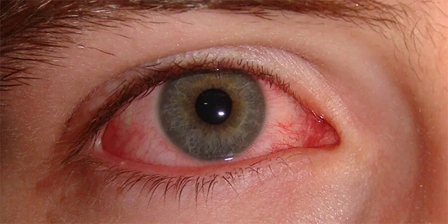 Conjuntivitis Alérgica