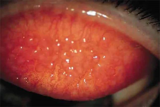 Conjuntivitis Alérgica