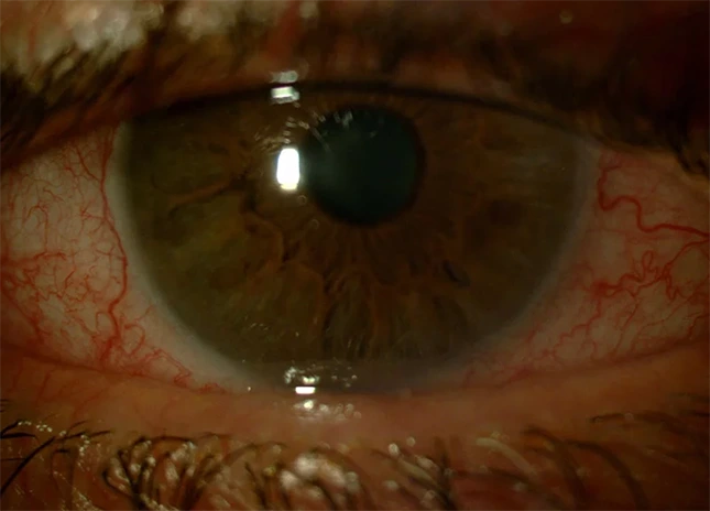 Conjuntivitis Viral