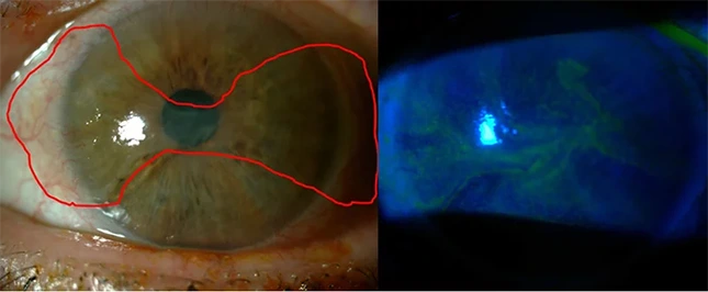 Paciente con tumor limbar previo quimioterapia en gotas.