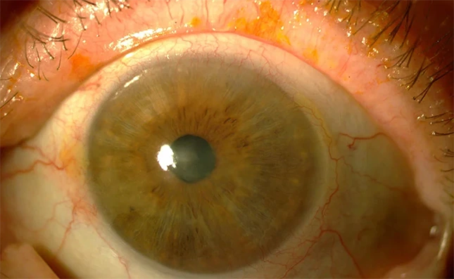 Paciente con tumor limbar previo quimioterapia en gotas.